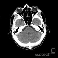 CT-posnetek glave