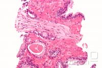  Slika Adenokarcinom (najpogostej&#353;i tip raka na prostati) pod mikroskopom